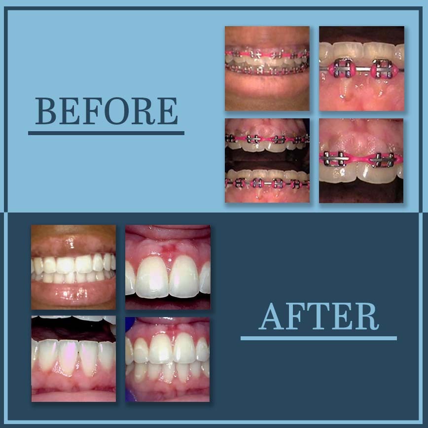 Before and After of gingivectomy